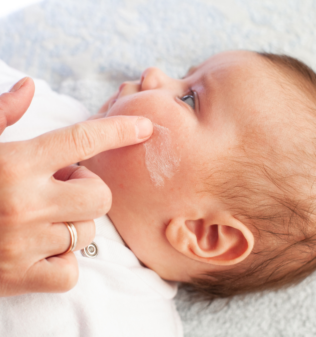 Creams for Eczema