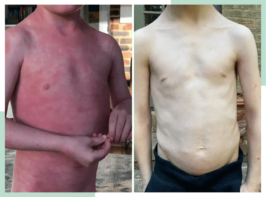 dr-ana-eczema-transformations-1-.png