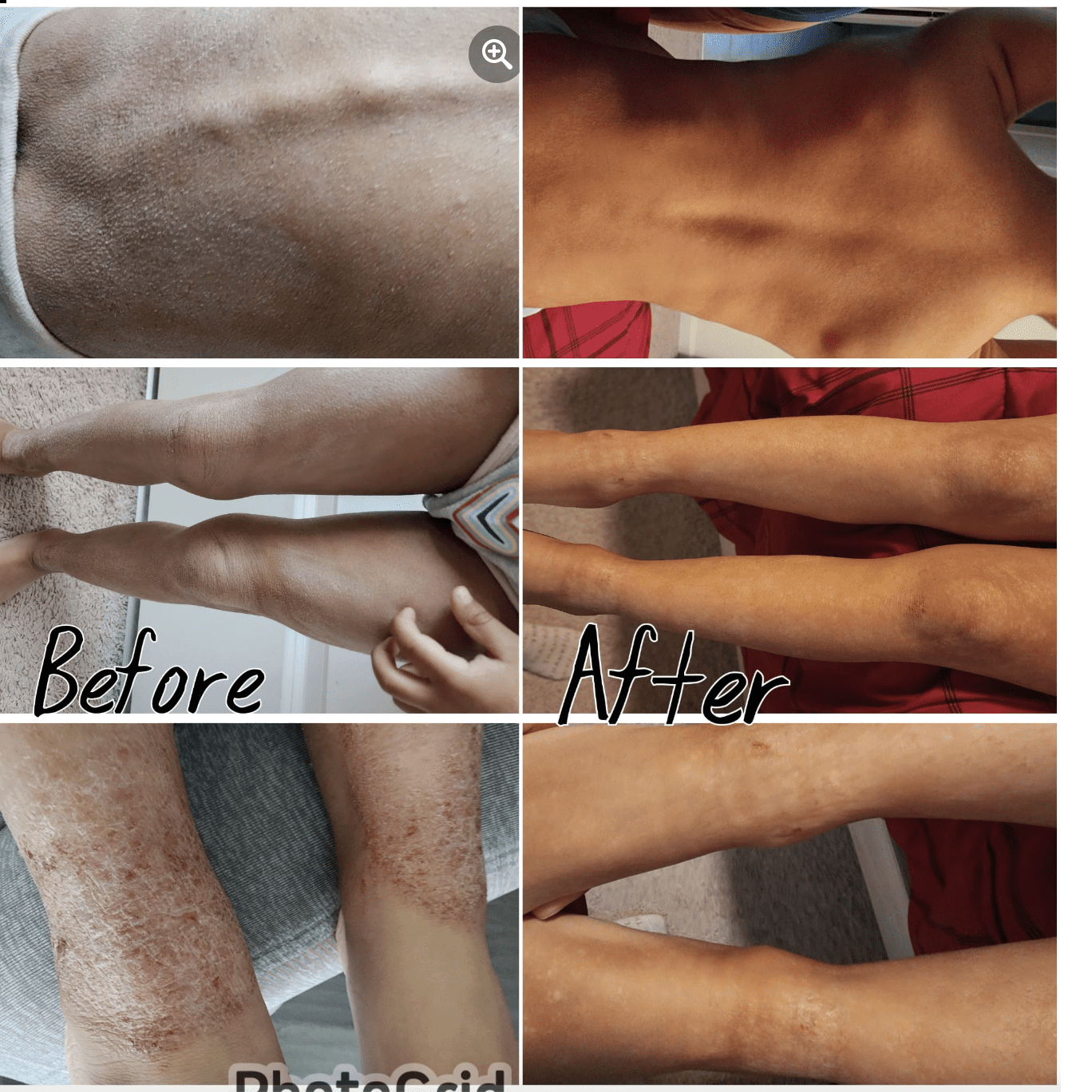 Andrea's skin transformation from healing eczema